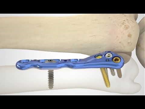 Acu-Loc® 2 Volar Distal Ulna Plate Surgical Technique Overview Animation