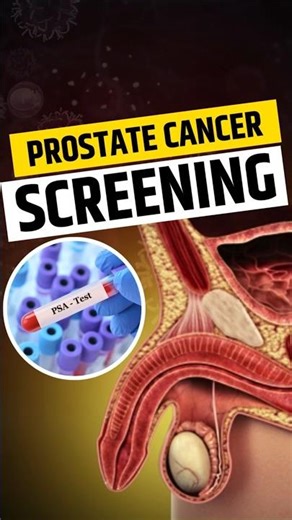 प्रोस्टेट कैंसर की जांच कैसे होती है? | Prostate Cancer Screening Test | PSA Level, DRE & MRI