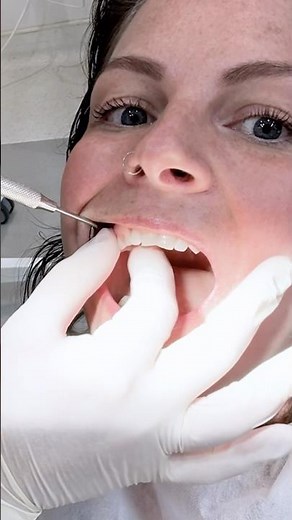 Melody's SHINING Smile Revealed | Teeth Whitening in Antalya Turkey