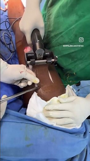 Skin graft using electric dermatome I Dr Prajwal I Plastic Surgeon