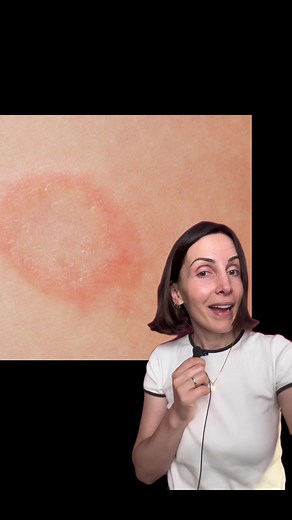 Ringworm: Causes, Symptoms, and Fast Cures