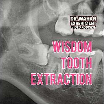 Horizontal Wisdom Tooth Extraction