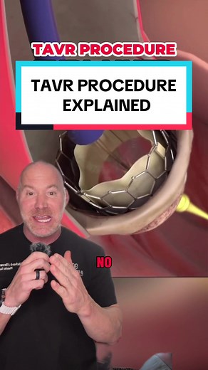 TAVR Procedure: Minimally Invasive Heart Surgery Explained