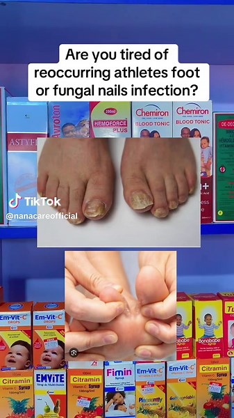 Effective Treatment for Athlete's Foot and Fungal Nails