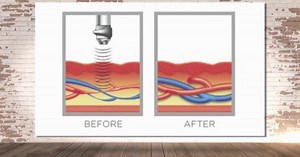 E.D. happens to men of all ages, but there's one treatment that promises to work for almost everyone