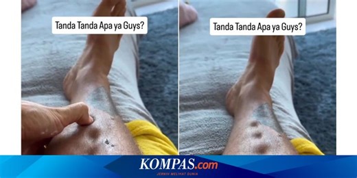 Cekungan di Kaki Tak Kembali Normal Usai Ditekan, Tanda Penyakit Apa?