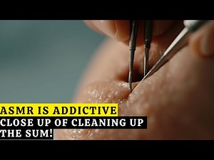 30 MINUTES OF ASMR BLISS! Extreme Acne & Pimple Popping