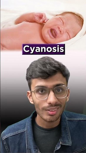 What is Blue baby Syndrome? #medical