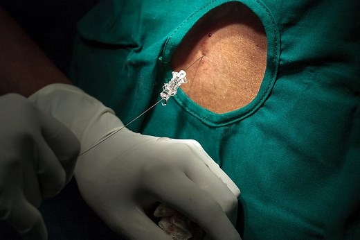 Płyn mózgowo-rdzeniowy - skład, funkcje, badania