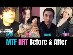 MTF Before vs After HRT: You Won’t Believe the Difference!