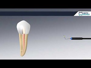 Meta Biomed EQV Endodontic Obturation System - How To Use - DENTBEAR