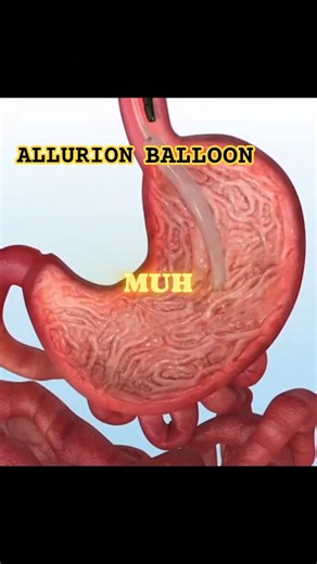Allurion Gastric Balloon Explained In 3D| #shorts