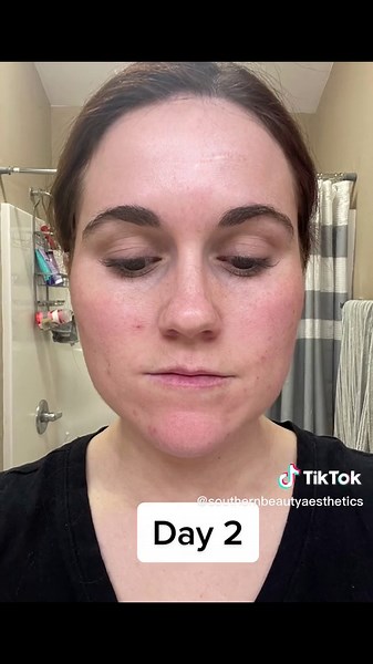 VI Peel Process: Step-by-Step Guide to Aesthetic Chemical Peels