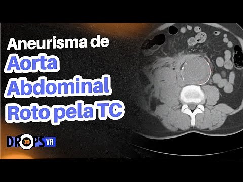 COMO RECONHECER O ANEURISMA DE AORTA ABDOMINAL ROTO PELA TC I VOCÊ RADIOLOGISTA