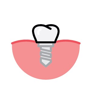 Dental Implants • Synergy Dental Clinic