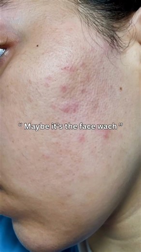 Skincare Routine For Acne Prone Skin #skincare #skincareroutine #shorts