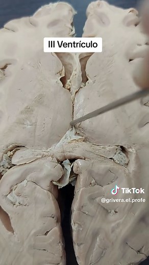 Tercer Ventrículo Encefálico: Anatomía y Función