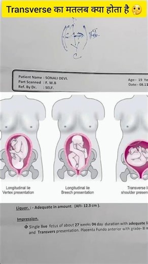 FWB Ultrasound Report Transverse presentation #ultrasound #shorts #shortsfeed #pregnancyultrasound