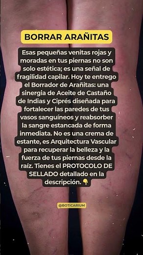 ARAÑITAS VASCULARES 🕸️ El Secreto para Borrarlas de tus Piernas.
