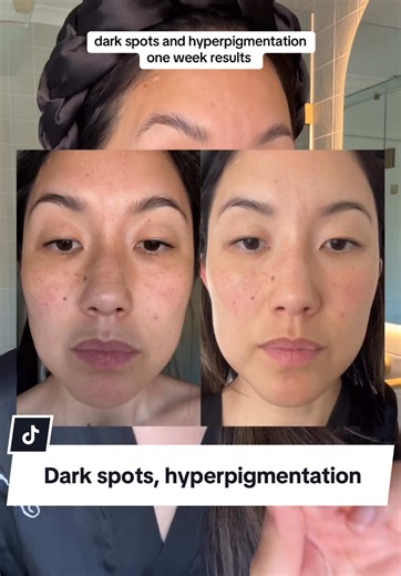 La Roche-Posay Mela B3 Serum: Dark Spot Preview Results