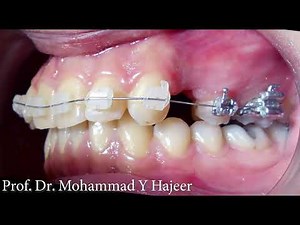 Treatment of maxillary protrusion by maxillary premolar extraction only -Prof. Dr. Mohammad Y Hajeer