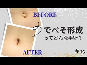 でべそ形成ってどんな手術？前編