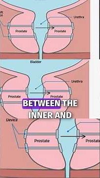 Understanding the UroLift Procedure: Your Questions Answered #shorts
