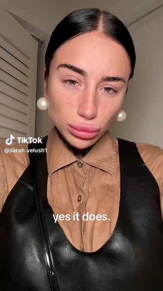 Lip Filler Transformations: Before and After Insights