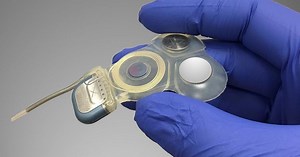 Inner ear implant helps restore balance to vertigo sufferers