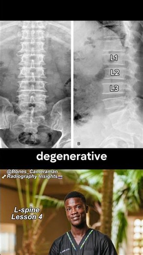 Lumbar Disc Narrowing on X-Ray | How to Identify It in 60 Seconds