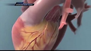 A look at how FH can lead to cardiovascular disease