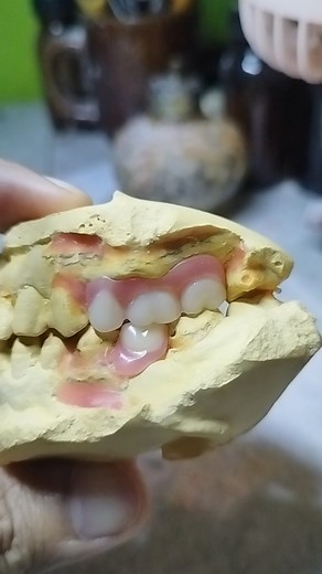 Upper and lower partial denture ordinary | Alberto Orbeta RDT | Facebook