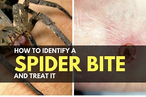 How to Identify a Spider Bite and Treat It | TruePrepper