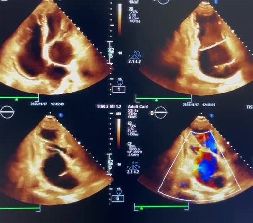 *Cor triatriatum*  is an extremely rare congenital heart defect , where a thin membrane divides one of the heart upper chambers (atrium) into two parts resulting in three atrium chambers instead of… | Marzieh Khayatzadeh