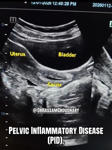 Understanding Cervical Ultrasound Findings