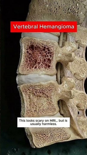 MRI Report Scared You? 😨 The TRUTH About Slipped Disc, Disc Bulge & Back Pain!