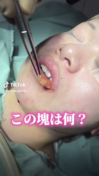 この塊は何？#小顔整形 #整形 #バッカルファット | buckle face removal