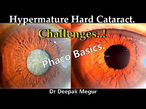 Principle to follow during Phacoemulsification in Hard Cataract - Phaco Basics - Dr Deepak Megur