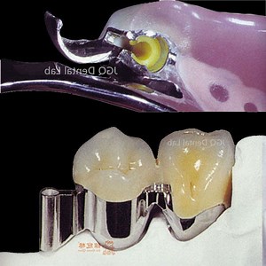 [Hot Item] Long-Term Restoration Key Key Way Metal Dental Attachment Milling with Pfm Teeth