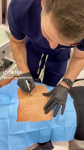 Do you suffer with excessive back sweating? Superficial toxin injections block the nerve signals responsible for sweating, stopping the sweat glands from producing too much sweat. #candycrush10 #fyp #tiktok #foryoupage #viralvideos #funnyvideos #duet #love #recipe #memes #aestheicsliverpool #aesthetics #aestheticspractitioner #toxin #antisweat #liverpool #scouser