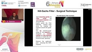 New Techniques for Repairing Hill-Sachs Lesion: The Hill-Sachs Filler