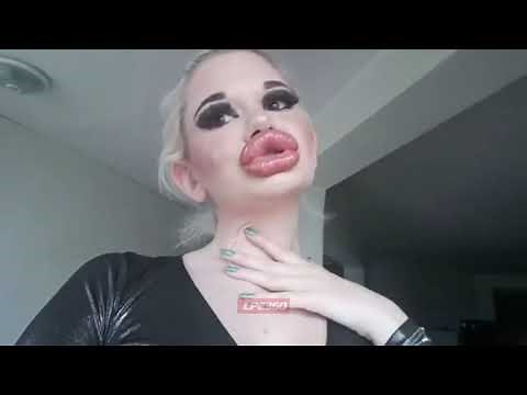 Woman with biggest lips in the world