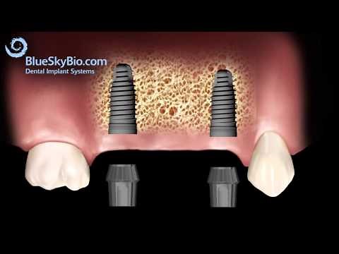 Patient Treatment Videos: Implant Bridge
