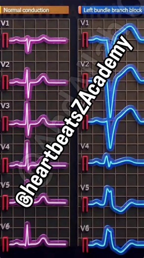 We all get confused... A clear visual guide to differentiating Left Bundle Branch Block (LBBB) and Right Bundle Branch Block (RBBB) on ECG. Key features at a glance: ◾️ LBBB (Left Bundle Block): · Dominant S in V1 · Broad monophasic R in lateral leads (I, aVL, V5-6) · No Q waves laterally · QRS > 120ms ◾️ RBBB (Right Bundle Block): · RSR' pattern in V1-3 ("M-shaped") · Wide, slurred S wave in lateral leads · QRS > 120ms Essential for quick, accurate interpretation. This visual breaks it down. Sa
