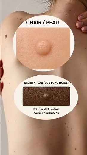 🤔 Savez-vous reconnaître un grain de beauté normal ? Tous les grains de beauté ne se ressemblent pas