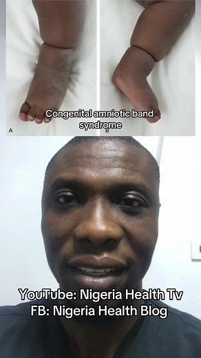 Congenital Amniotic Band Syndrome: Causes, Symptoms, and Treatment