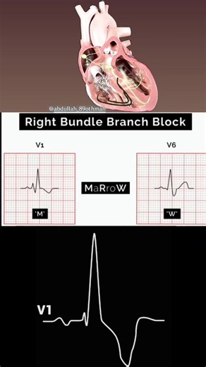 77K views · 589 reactions | Bundle Branch Block (RBBB) https://www.facebook.com/share/r/1EFAqyJyxH/ detailing the conduction system, key causes, and ECG patterns.  Like |  Share |  Tag a colleague | ⏳ Save for later. #Cardiology #Healthcare #BundleBranchBlock #ECG #MedicalEducation | Abdallah Othman | Facebook