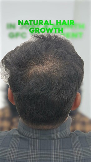 GFC Hair Treatment Result After 6 Months Real Hair Results🔥