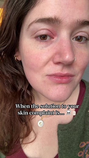 Starting Soolantra for Rosacea Management