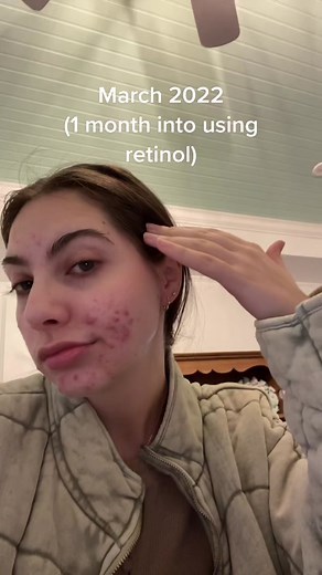 Retinol Purging: Journey, Before & After Acne